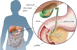 دمنوش ها و  دیگر خوراکی های مناسب برای پس از عمل جراحی صفرا